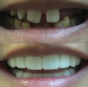 Snap On Smile (PL) 3