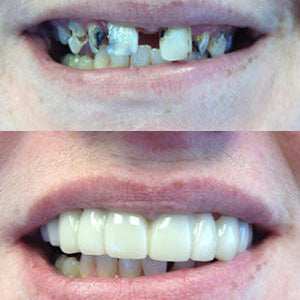 Snap On Smile (PL) 2