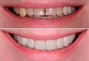 Snap On Smile (PL) 9